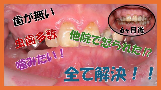 二度と虫歯にならないゴールドインレー | びわ湖大津デンタル