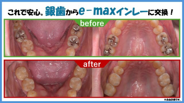 二度と虫歯にならないゴールドインレー | びわ湖大津デンタル