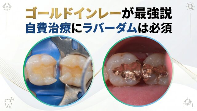 二度と虫歯にならないゴールドインレー | びわ湖大津デンタル