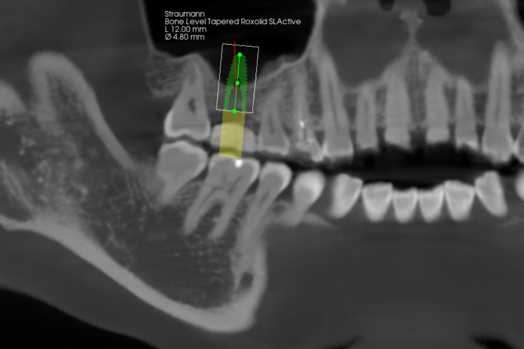 残存骨高4.6mmに対して直径4.8mm・長さ12mmのインプラントを計画したCT画像
