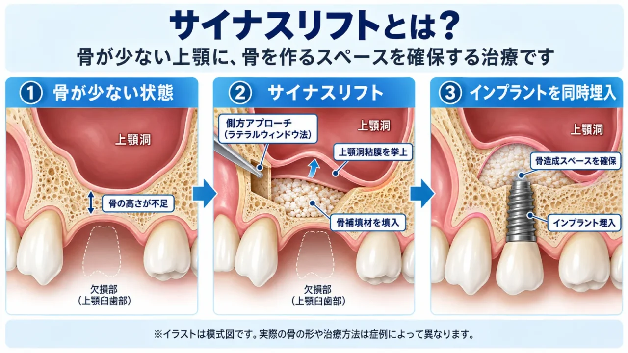 サイナスリフトの模式図